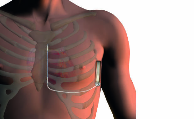 Graphische Darstellung einers männlichen Oberkörpers mit eingesetztem Defibrillator.